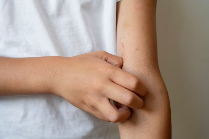 «Инопланетная аллергия» угрожает россиянам: уфимцы массово покрылись неизвестной сыпью