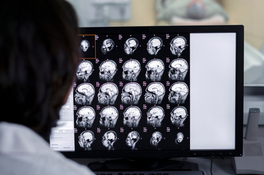 Врач-онколог вылечил неизлечимый рак мозга экспериментальным методом