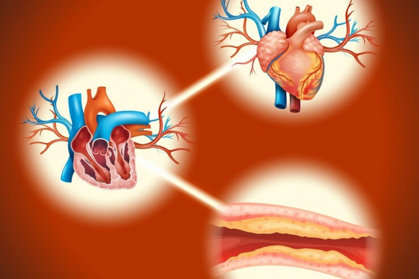 Эти популярные продукты питания могут привести к закупорке сосудов